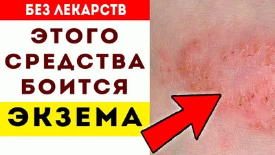 Варикозный дерматит - статьи медицинского центра доктора Бегмы в Москве