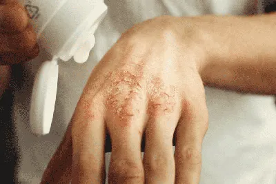 Дерматит: как выглядит на коже, причины, симптомы, препараты для лечения