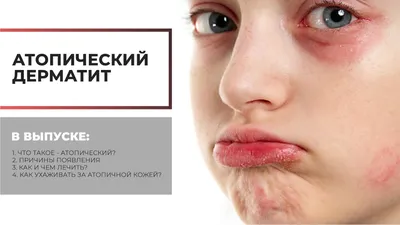 Микоз кожи стоп, ногтей, головы, рук | Лечение микоза у ребенка и взрослого  в Клинике подологии Полёт в Москве