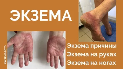 Экзема на руках: причины и как с ней бороться - МЕТА