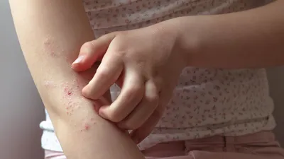 Лечение заболеваний кожи в Алматы и Нур-Султане 🤔
