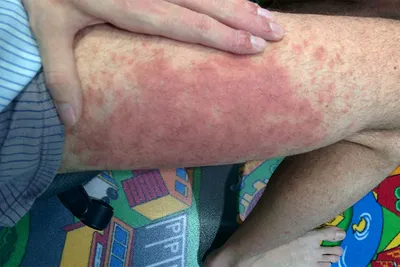 Blog | Что такое дерматит? Почему это происходит? Как это лечится?