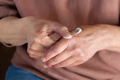 Сухие руки, кожура, контактный дерматит, грибковые инфекции стоковое фото  ©Aboutnuylove 140921290