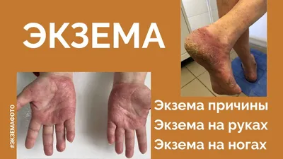 Мощный аллергия, экзема на руках. Красная некорректная кожа с волдырями  Стоковое Изображение - изображение насчитывающей заболевание, волдырем:  211285823