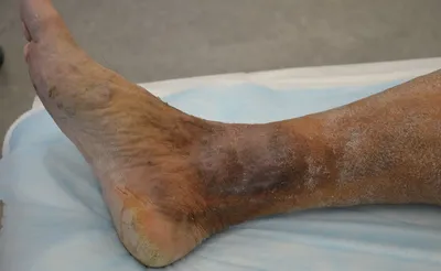Дерматит на ногах (ступнях ног): лечение, причины, симптомы, профилактика,  народные средства - YouTube