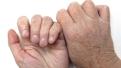 ᐈ Как лечить экзему? ~【Симптомы и диагностика в Киеве】