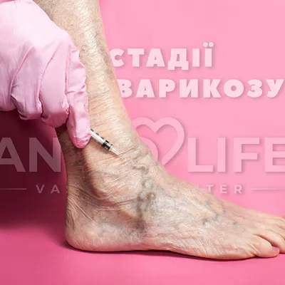 Экзема у пожилых. Как добиться ремиссии . Новости Опека в Челябинске
