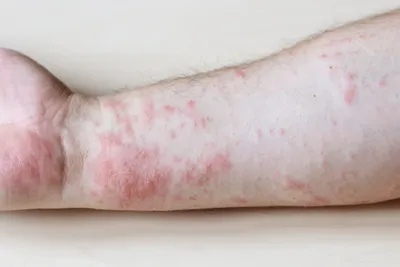 Красные пятна на коже: появились и чешутся после укусов, на коже рук, ног у  детей и взрослых