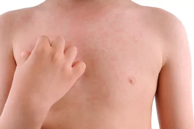 Атопический дерматит на теле кожи на белизне Стоковое Изображение -  изображение насчитывающей дерматология, москит: 125240629
