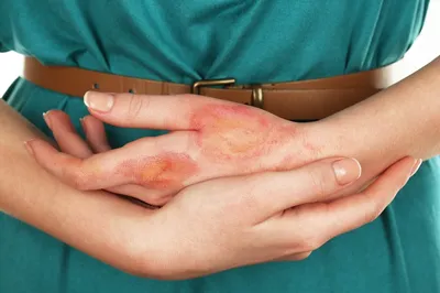 Лечение дерматита - диагностика, цены в Люберцах, записаться на прием к  дерматологу | KRH Medical