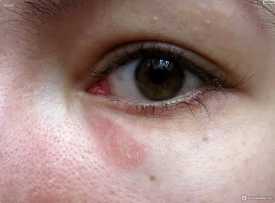 Сухая кожа вокруг глаз: 5 причин и что делать с сухостью