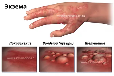 Экзема: причины, чем лечить и мазать, как выглядит экзема на руках, ногах,  лице и пальцах