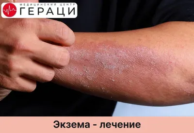 Пост благодарность Пикабушнице. Или победа над экземой | Пикабу