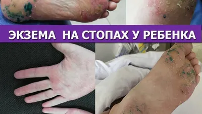 Экзема ладоней и подошв | Аллергология и Иммунология