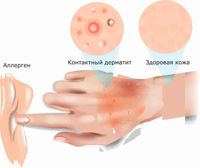 Экзема на руках: симптомы профилактика и лечение - Здоровье 24
