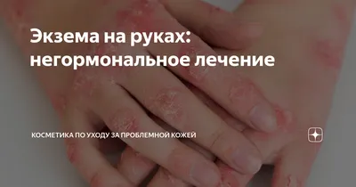 Экзема на руках — это заболевание кожи, которое порой может привести к  сильному дискомфорту и боли. Тем не менее, существуют ряд мер… | Instagram