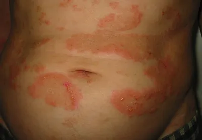 Средства для лечения аллергии Shering-Plough. Тридерм мазь - «Лечим  пелёночный дерматит за 1 день, фото)» | отзывы