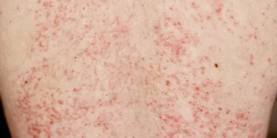 Красная сыпь на животе: симптомы и причины, что делать, прогноз