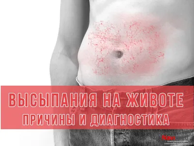 красная аллергическая сыпь на животе атопическая дерматит экзема. женщина,  подающая мазь Стоковое Изображение - изображение насчитывающей дерматит,  зудяще: 232686595