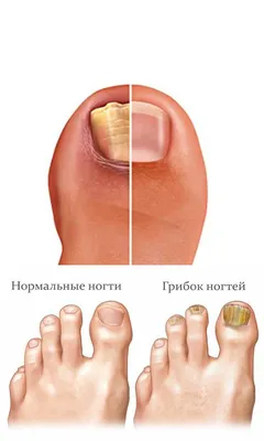 Онихолизис ногтей – симптомы, причины, виды, способы лечения и профилактики  болезни