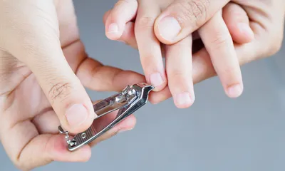Лечение грибка ногтей в Кирове лазером в клинике Возрождение