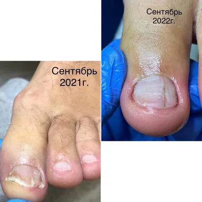 Экзема на ногтях (рук и ног) - причины, лечение, симптомы, профилактика –  Лостерин