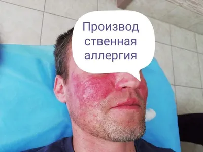 Дерматомикоз: причины, симптомы, лечение - Лайфхакер