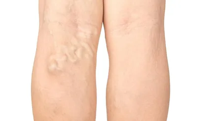 Как лечить варикоз на ногах у женщин: признаки, симптомы и причины.  Обсуждение на LiveInternet - Российский Сервис Онлайн-Дневников