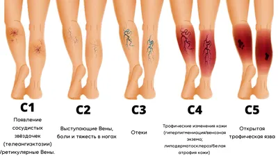 Варикоз на ногах - новая статья от Клиники в Уручье