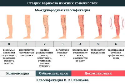 Варикоз на ногах: лечение, симптомы, профилактика