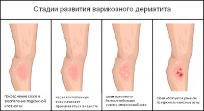 Варикозный (венозный) дерматит на ногах - лечение | Медицинский центр  ФлебоПлюс