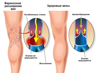 Операции при варикозе - статьи | Центр Инновационной Флебологии