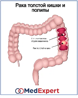 РАК ОБОДОЧНОЙ (ТОЛСТОЙ) КИШКИ | MED Expert
