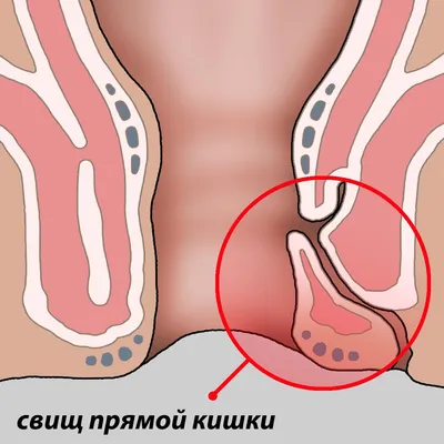 Свищ заднего прохода может привести к осложнениям.