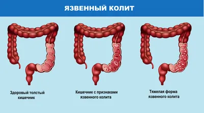 Релиф Ультра суппозитории ректальные №12 - в наличии: 120+ аптек Киев Львов