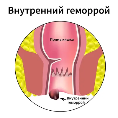 Колит - причины появления, симптомы заболевания, диагностика и способы  лечения