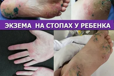 Экзема, причины и симптомы ≡ Блог MED CITY | Лечение и профилактика экземы  в Киеве