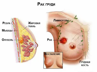 Реальные признаки рака молочной железы