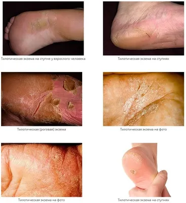 экзема или грибковая инфекция ног Стоковое Изображение - изображение  насчитывающей зудяще, экзема: 230757819