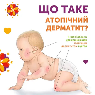 ⚕ Что такое атопический дерматит? - PULSE