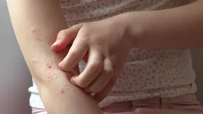 Лечение атопического дерматита у взрослых и детей. Запишитесь к  дерматовенерологу в Киеве!