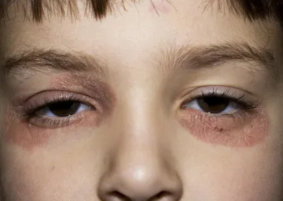 Названо заболевание, на которое нужно проверить детей с раздраженной кожей  - Газета.Ru