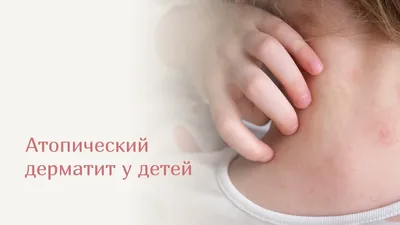 Атопический дерматит у ребенка — 30 ответов | форум Babyblog