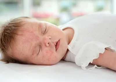 Бальзам La Roche Posay LIPIKAR BAUME AP+M - «Эффективный эмолент при  атопическом дерматите у ребёнка. » | отзывы