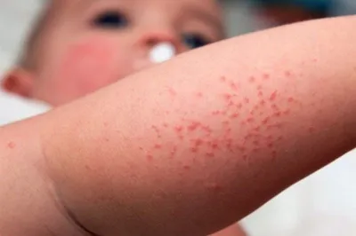 Как распознать контактный дерматит у ребенка: красные кисти рук,  покраснение кожи