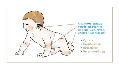 Уход за детской кожей в домашних условиях - «Атопический дерматит у  грудничка... Лечить или ждать, когда \"перерастёт\"? Как ухаживать за кожей?  Использовать ли гормональные мази? Теперь я знаю ответы на эти вопросы.» |