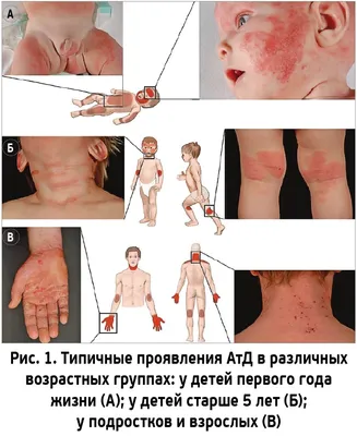 Дерматит у детей - причины, симптомы, диагностика и лечение дерматита у  ребенка | MUSTELA