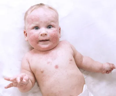 Экзема новорожденного атопического дерматита ног стоковое фото  ©philfreez@gmail.com 121400704