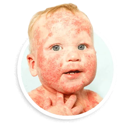 педиатрический экзема или атопический дерматит у младенцев и детей.  Иллюстрация вектора - иллюстрации насчитывающей младенец, новорожденного:  242637882