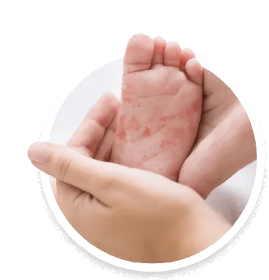Атопический дерматит у грудничка👶 легко обостряется после  непродолжительного выздоровления, если неправильно ухаживать за нежной  кожей и… | Instagram